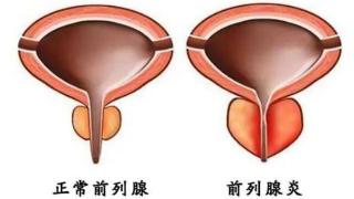 大蒜是前列腺炎的“发物”？医生：保护前列腺，尽量多吃这5物