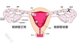 一侧输卵管阻塞会影响怀孕吗？