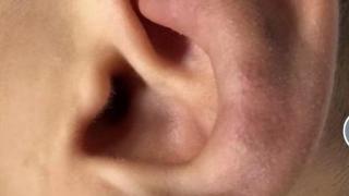 动静脉畸形科普系列之耳朵动静脉畸形微创介入治疗分享