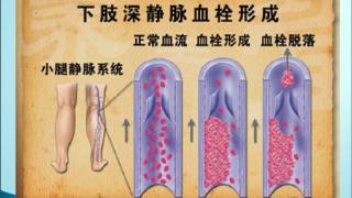 帮你了解什么是下肢深静脉血栓后综合征