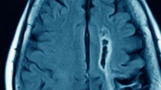 轻度脑萎缩治疗方法是什么，主要包括三点