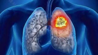 提醒：肺部病变早期，通常有“1粗、1麻、2痛”，建议自测下