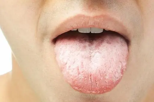 中医舌诊：看舌苔知健康，原来如此简单！