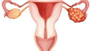 女性身体出现3大异常，要警惕卵巢癌，尤其是这3类易染人群！