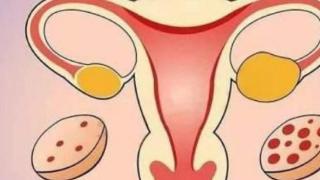 多囊卵巢综合症的表现有哪些？患了后就不易怀孕吗？
