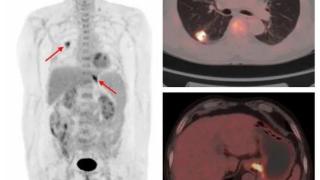 健康科普 | PET/CT在多原发癌诊断中的价值