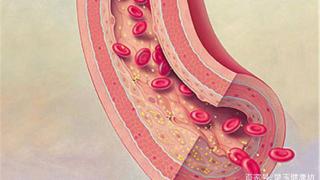 它是天然的“血栓对手”，坚持吃一点，血液不粘稠，告别血栓