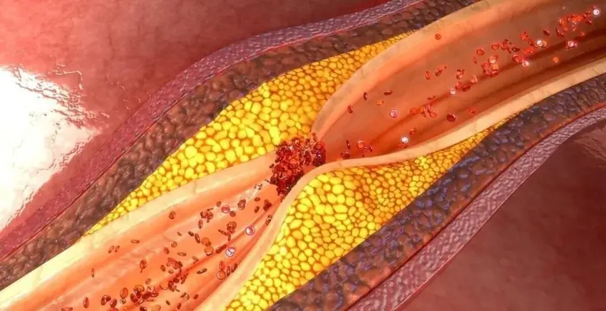 冠脉血管内抽出血栓后心梗很快缓解，血管斑块能抽出来吗？