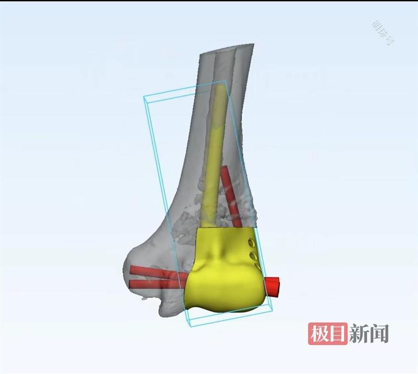 3D打印关节为男子精准保住手肘功能