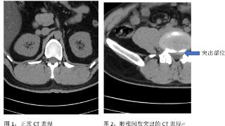 腰椎间盘突出了，内服中药也能“喝回去”？