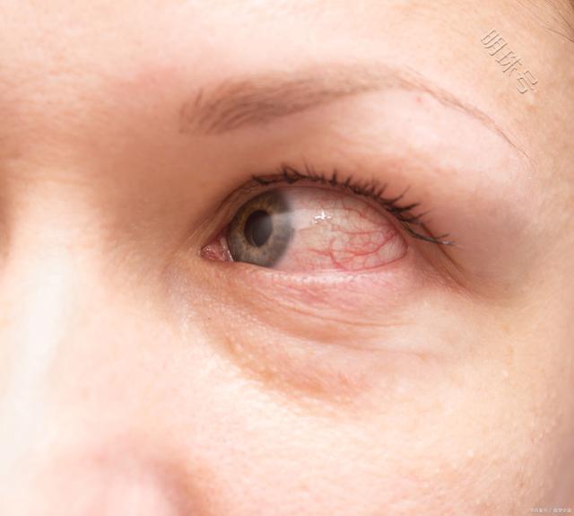病理性眼胞浮肿和生理性眼胞浮肿有什么不同之处