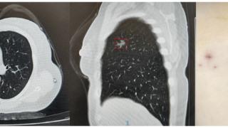 中西医“cp”组合助力肺结节患者快速康复