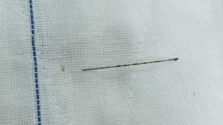女子腰痛做针灸，不料5厘米银针“游”进腰间