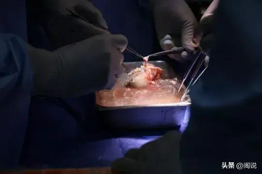 肾脏病人移植猪肾脏后去世！移植转基因猪肾，只延长了两个月性命