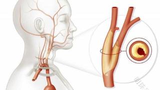 应该怎样治疗颈动脉斑块？医生告诉你答案，建议学习下