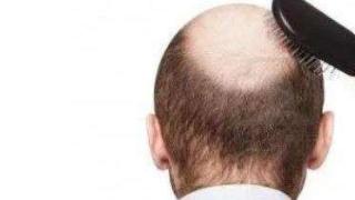 男人秃顶如何预防