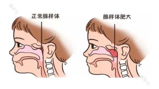 郑州民生耳鼻喉医院：别让腺样体肥大吓破胆！家长必知的那些事儿