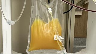 惊！血液中竟滤出一袋“油”！“双重血浆置换”帮助高脂血症患者避免严重并发症