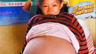 山西4岁女童肚子如孕妇，医生判定寿命3个月，房东大姐一语救奇迹