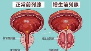 前列腺增生不再烦恼：老年男性自我照护手册