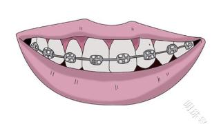 牙结石是怎样形成的?可能会造成哪些危害?一文学习下