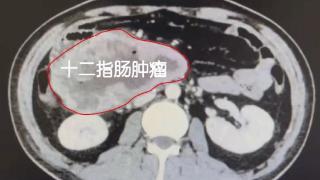 国庆我在岗⑤｜旅行途中“弃车”折返救援 肝胆外科8小时手术救回孩子父亲