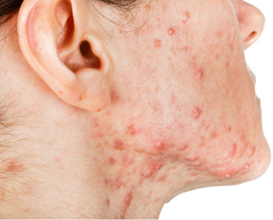 介绍几种常见皮肤病的有效预防措施
