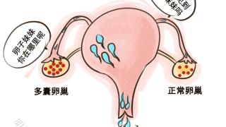 多囊难怀孕？NO!请收好这份怀孕攻略~