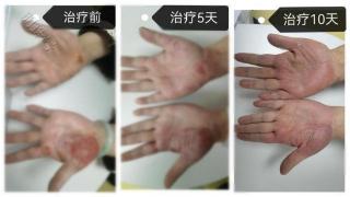 女子频繁清洁消毒手部，患上接触性皮炎