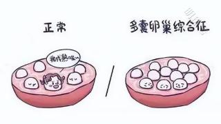 谁说多囊不能怀？多囊≠不孕！