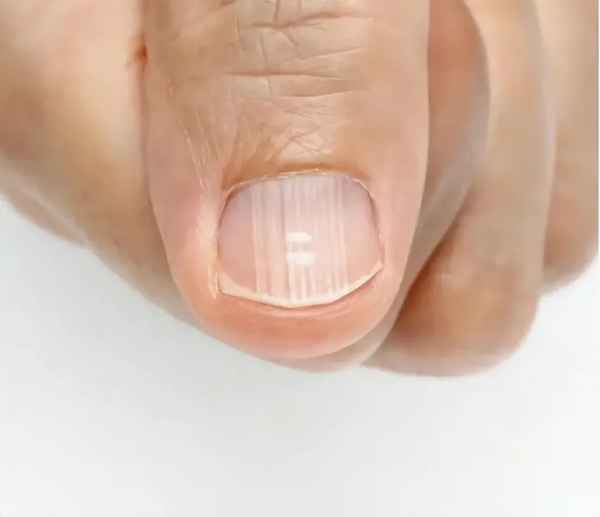 指甲上很多竖纹，可能是4种疾病的“暗示”？医生：不能忽视