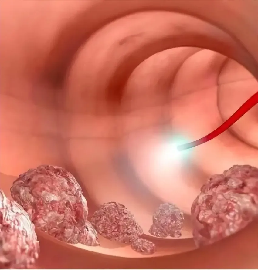 体内长了息肉，身体可能会有4个“警报”，不要小瞧息肉的危害
