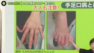 日本手足口病蔓延 东京连续7个星期指标超警戒值