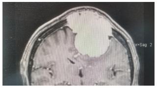 八旬瘫痪老人千里来青求医！青岛市中心医院帮他重新站起来