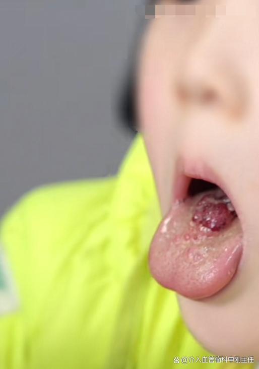 孩子舌头上有淋巴管囊肿，不必开刀也能治