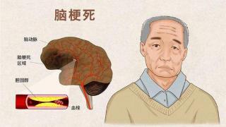 脑梗是怎么来的？提醒：睡觉时若出现3种现象，引起重视