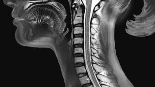 脊髓“图谱”为研究损伤提供新见解