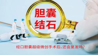 胆囊结石经口胆囊超级微创保胆手术后，还会复发吗？分析下