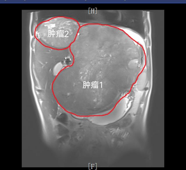 上海市公卫中心肝胆外科团队成功切除巨大肿瘤