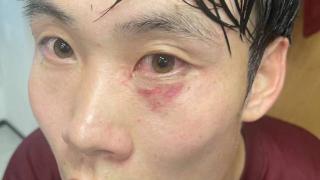 博主晒徐浩峰受伤照片，左侧眼眶和眼球均有淤血