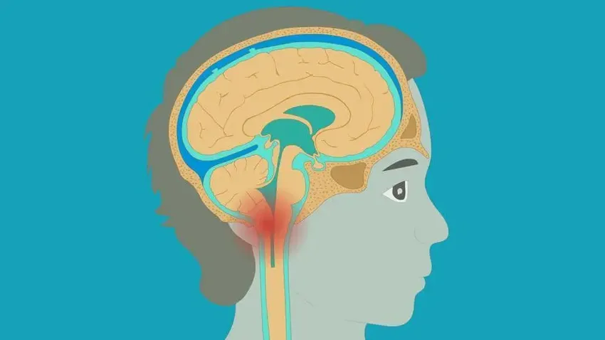 颅内“无声入侵者”：脑疝！不要忽视这些常见症状，做好三点预防