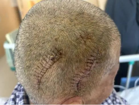 72岁老人头顶长出罕见囊肿 西医二附院为其成功切除