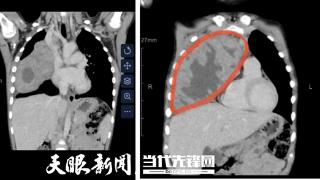 1公斤肿瘤似保龄球！上海儿童医学中心贵州医院、贵州省人民医院医生耗时5小时成功切除