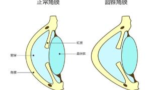 健康中国看山西：山西爱尔眼科医院 这一次，是角膜等人……