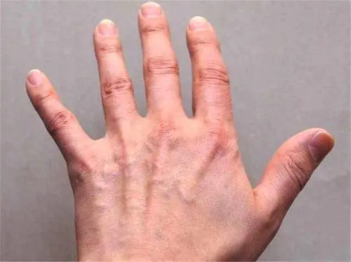 血糖异常，手指先知！医生：手上出现3个信号，你要警惕糖尿病