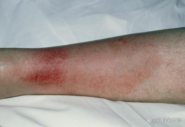 再次提醒：腿上有这种“红血丝”的人，可能是身体发出的危险信号