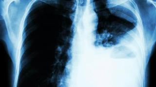 肺癌症状不只咳嗽，还有4个症状，建议看看