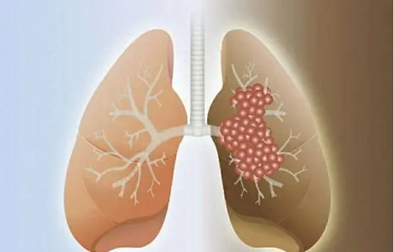 明明每年按时体检，为何查出肺癌还是中晚期?这个原因耽误很多人