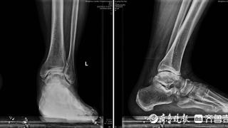 滕州市中心人民医院足踝外科成功开展踝关节置换术