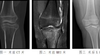 山东大学齐鲁医院（青岛）完成关节镜下手术